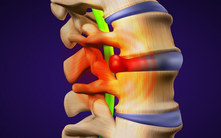 hernias-disco